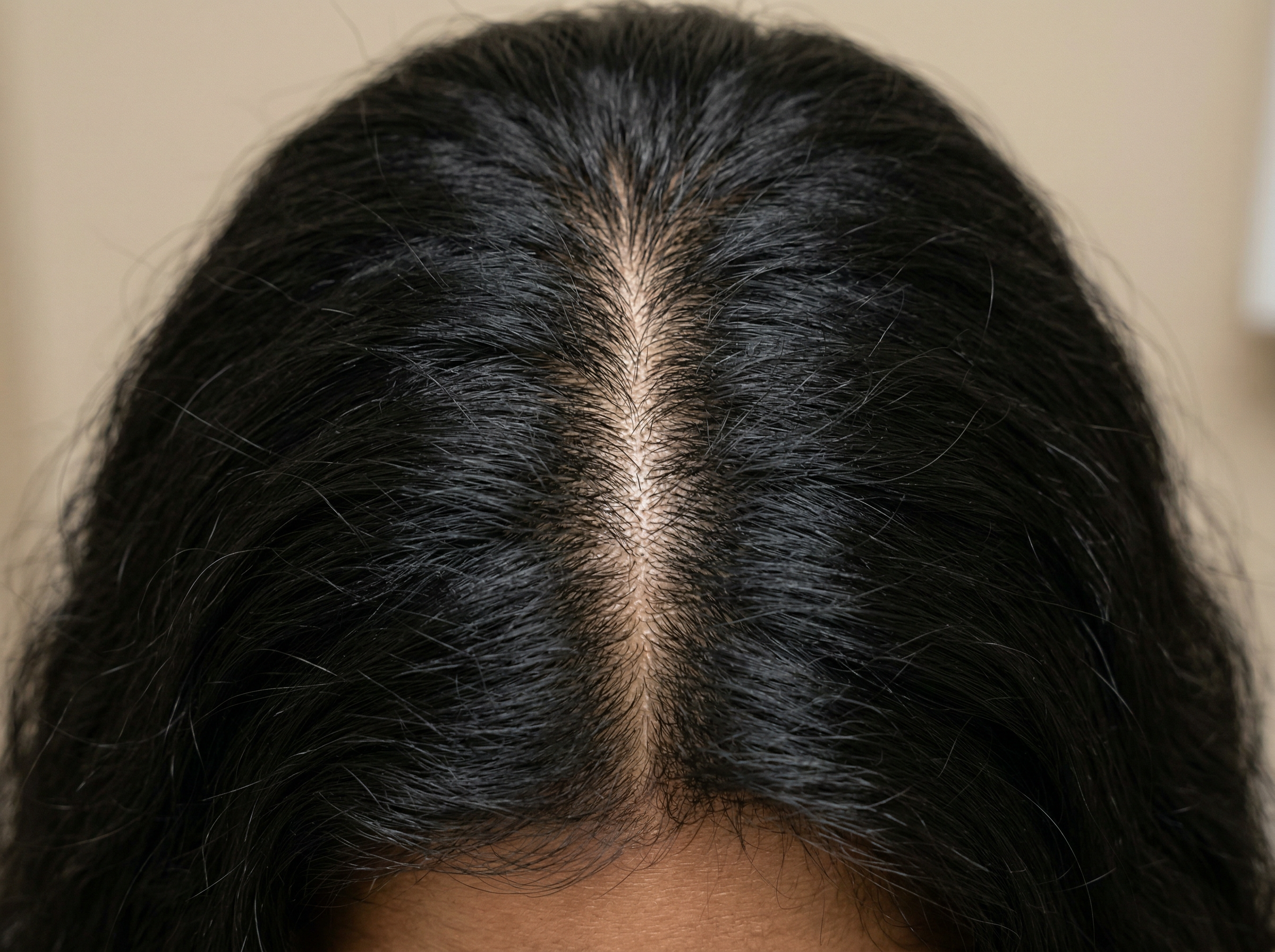 Healthy scalp with denser hair and baby hairs - Week 8